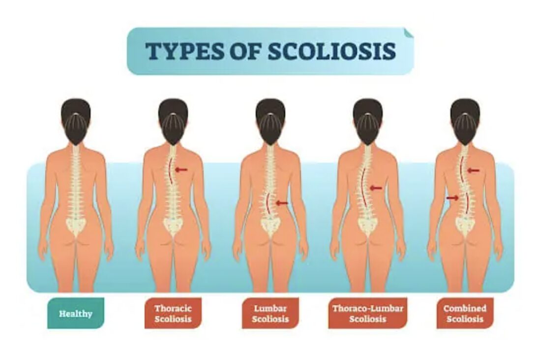 SCOLIOSIS: A GUIDE FOR CLIENTS 1 Screenshot 2024 07 09 at 10.22.16 AM